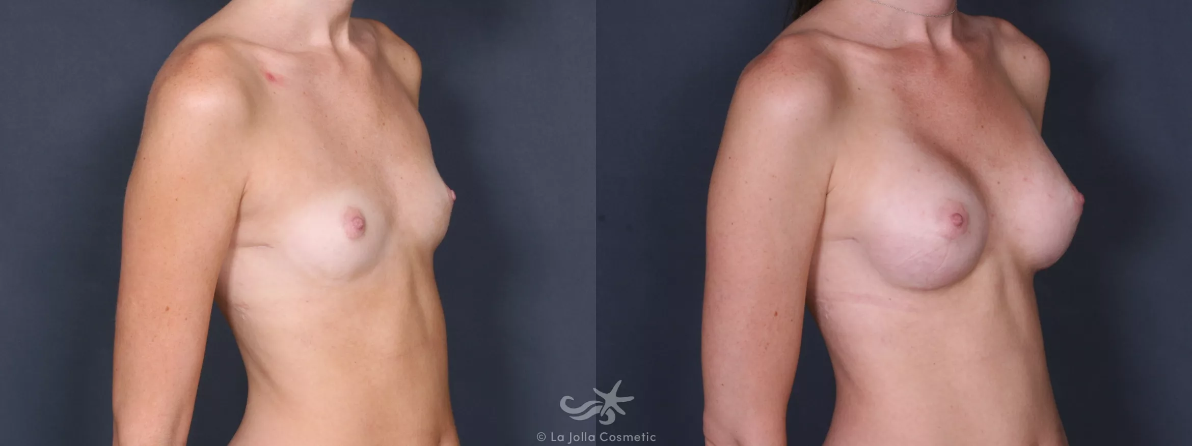Before & After Breast Augmentation Result 241 Right Oblique View in San Diego, CA
