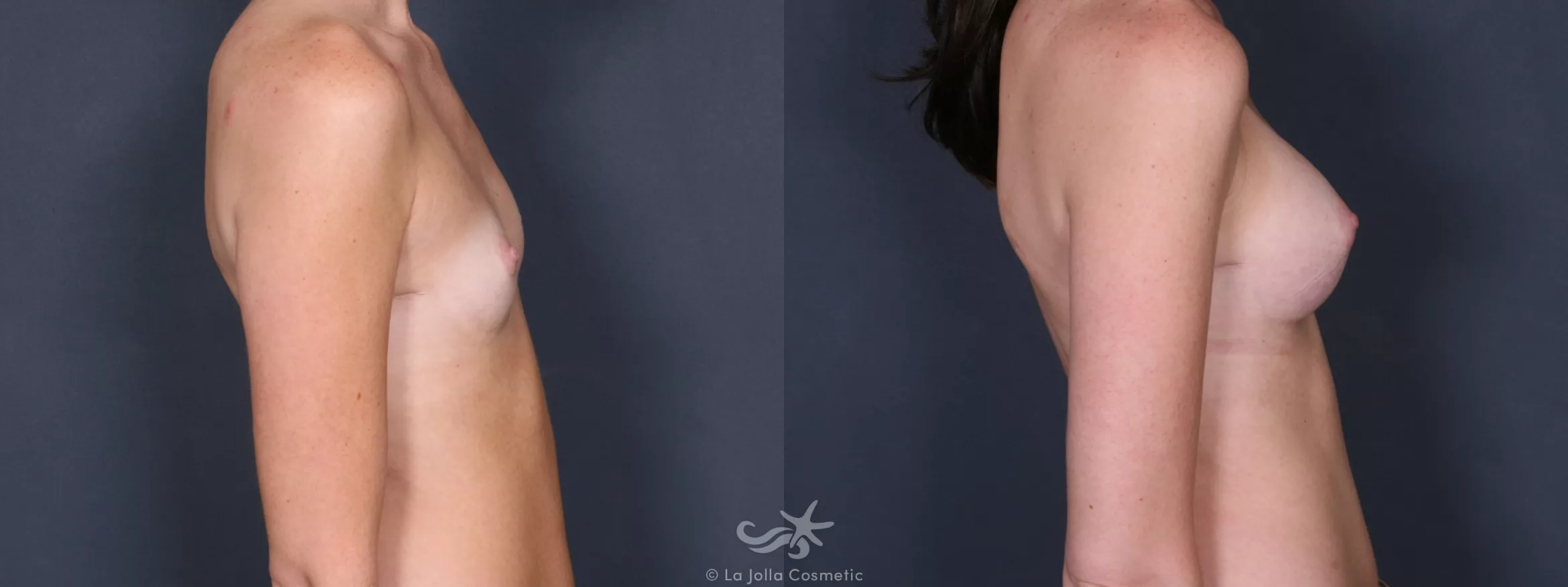 Before & After Breast Augmentation Result 241 Right Side View in San Diego, CA