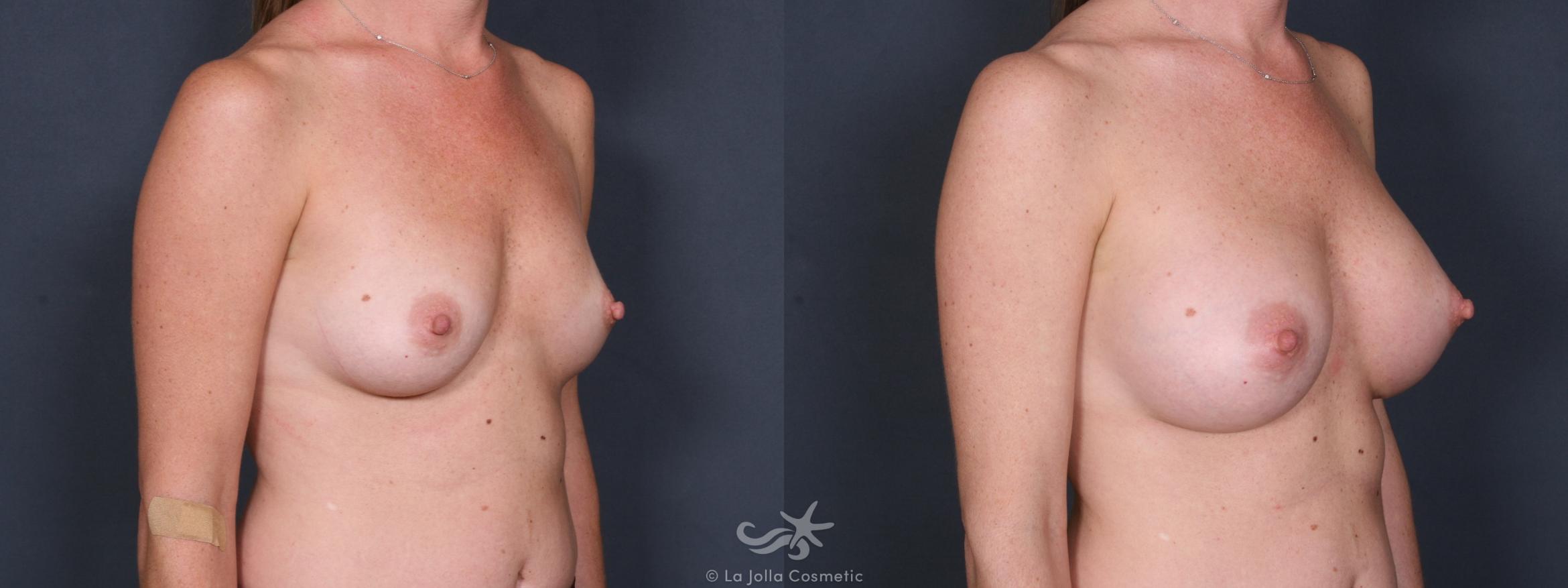 Before & After Breast Augmentation Result 242 Right Oblique View in San Diego, CA