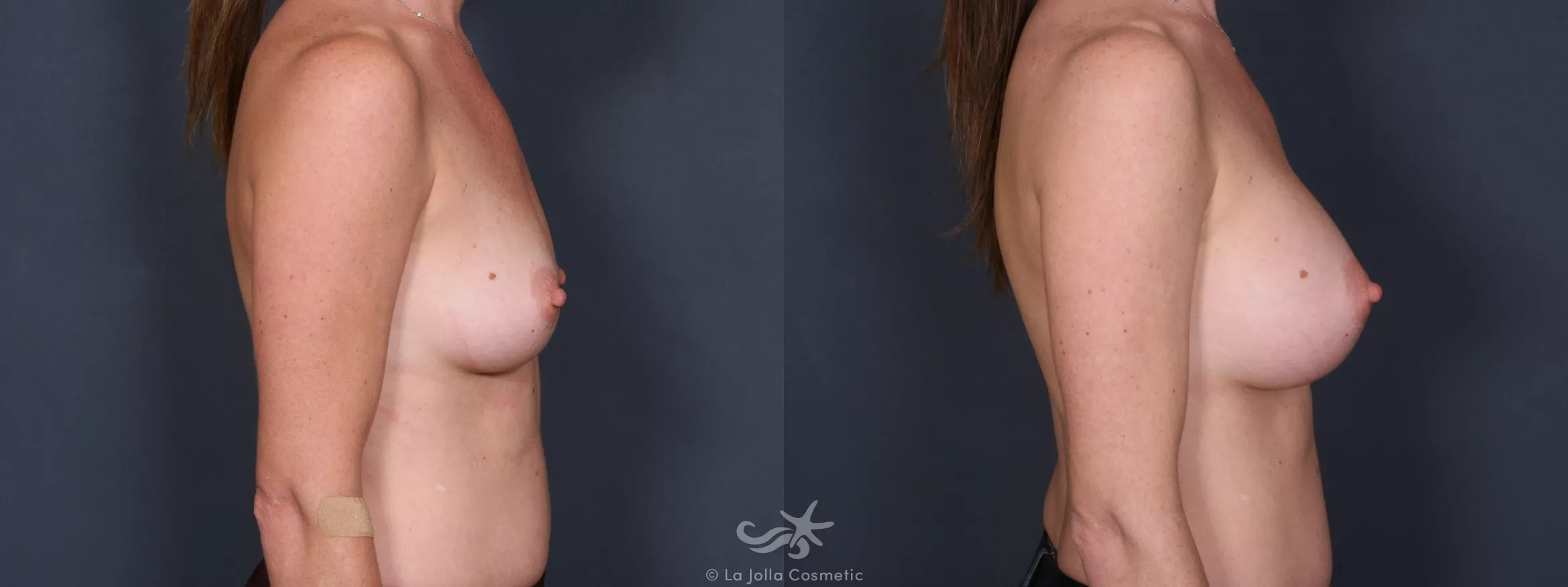 Before & After Breast Augmentation Result 242 Right Side View in San Diego, CA