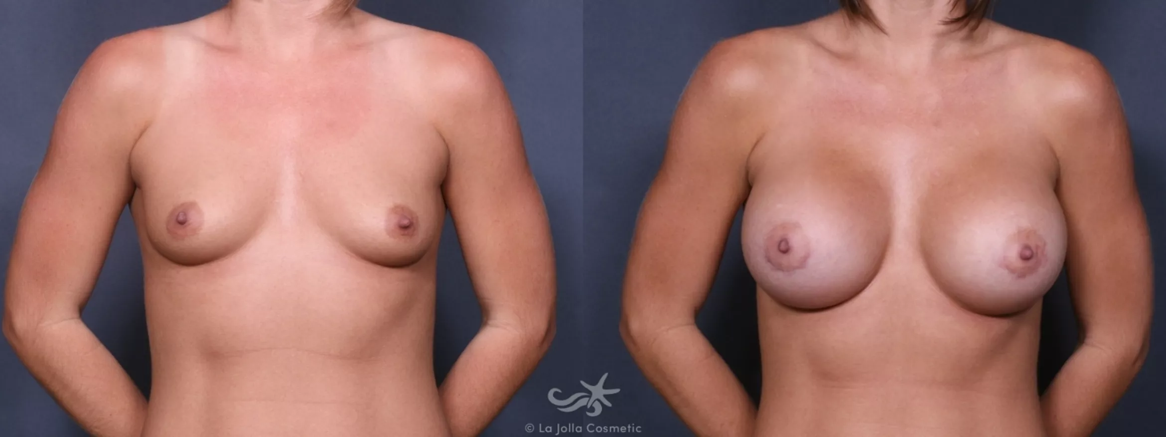 Before & After Breast Augmentation Result 245 Front View in San Diego, CA
