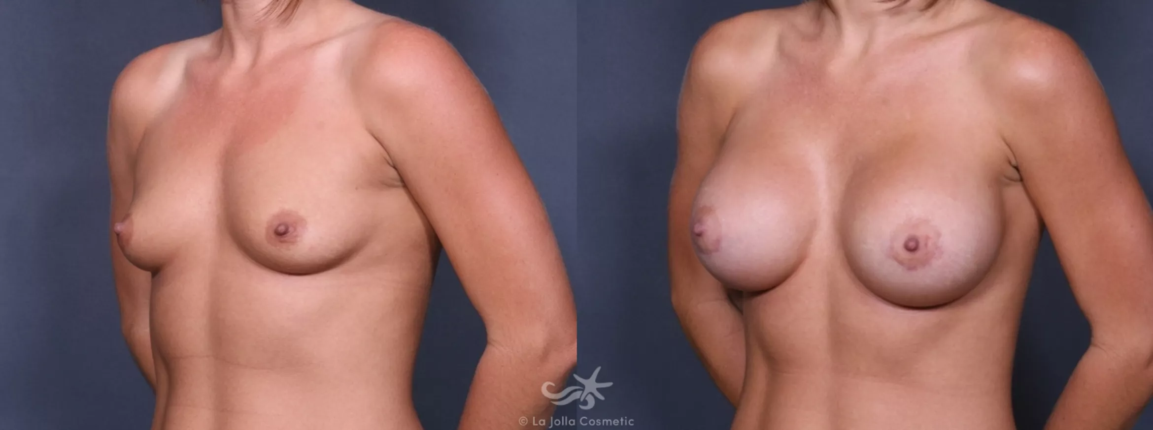 Before & After Breast Augmentation Result 245 Left Oblique View in San Diego, CA