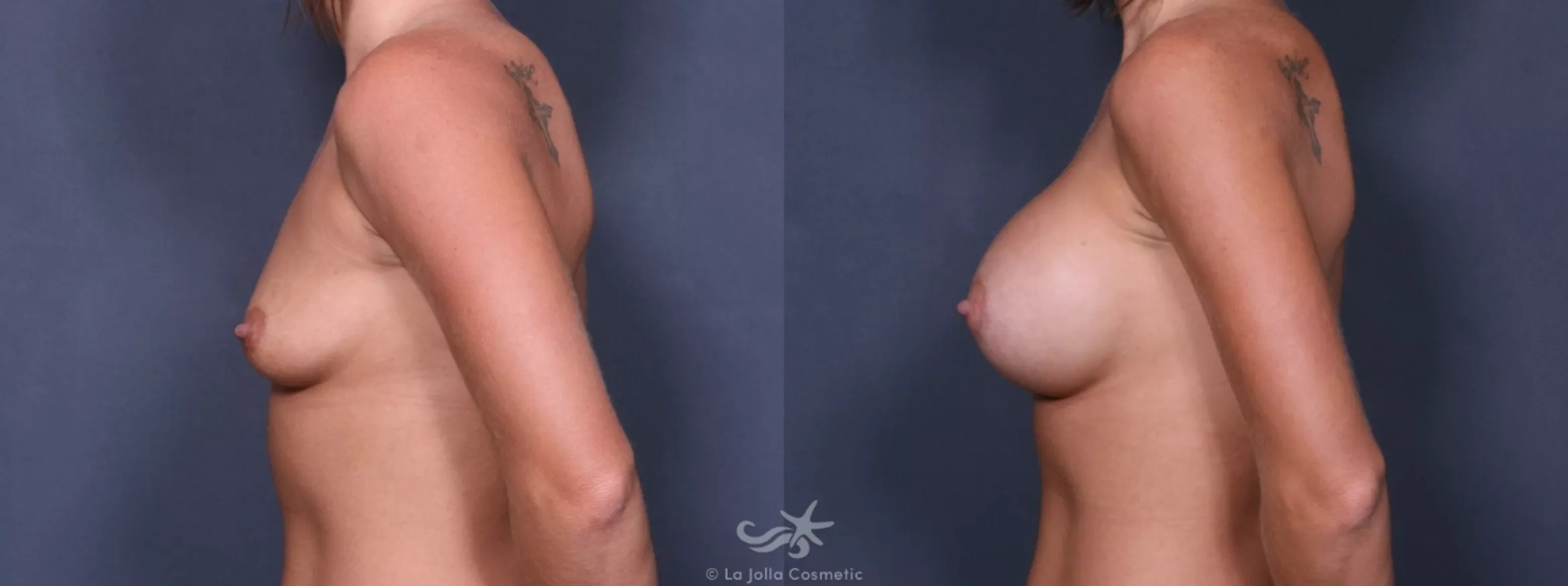 Before & After Breast Augmentation Result 245 Left Side View in San Diego, CA