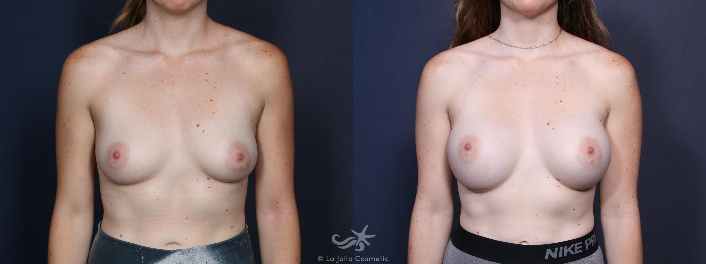 Before & After Breast Augmentation Result 25 Front View in San Diego, CA