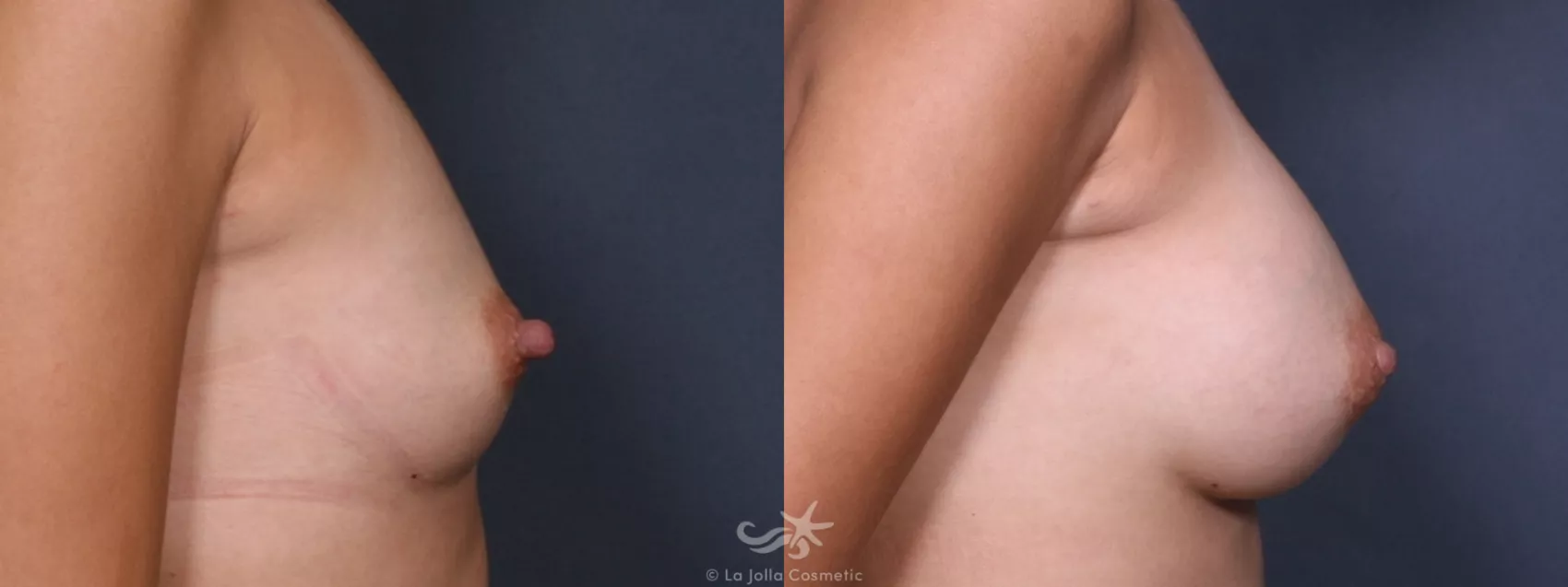 Before & After Breast Augmentation Result 250 Right Side View in San Diego, CA