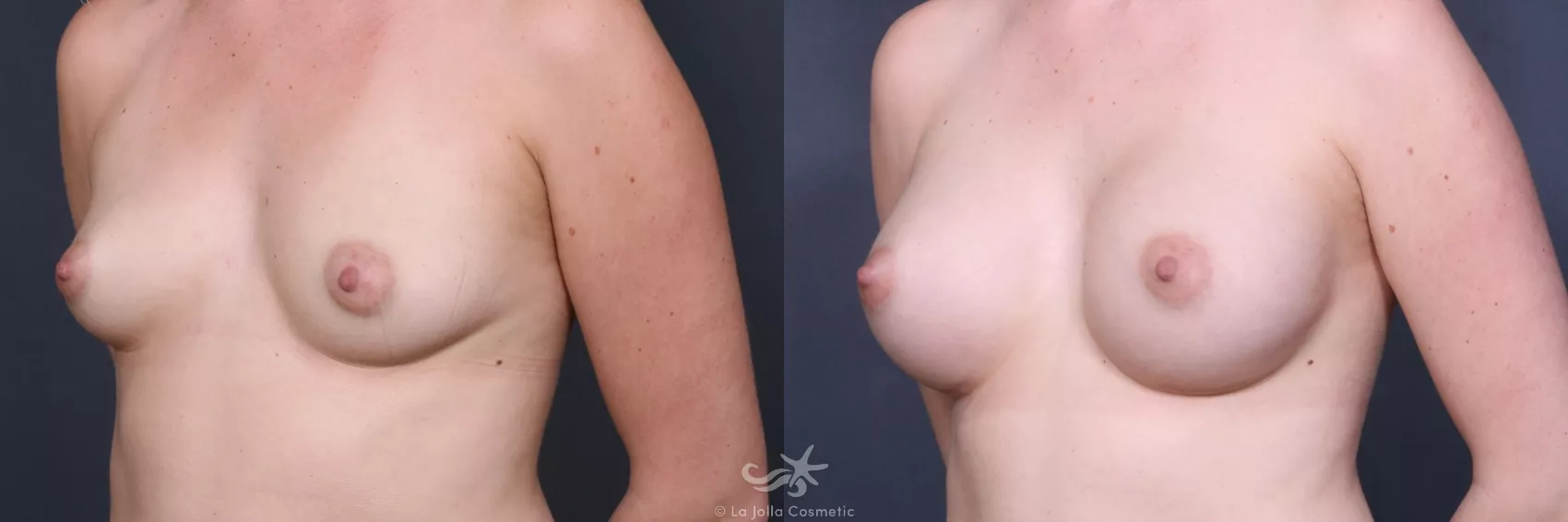 Before & After Breast Augmentation Result 251 Left Oblique View in San Diego, CA