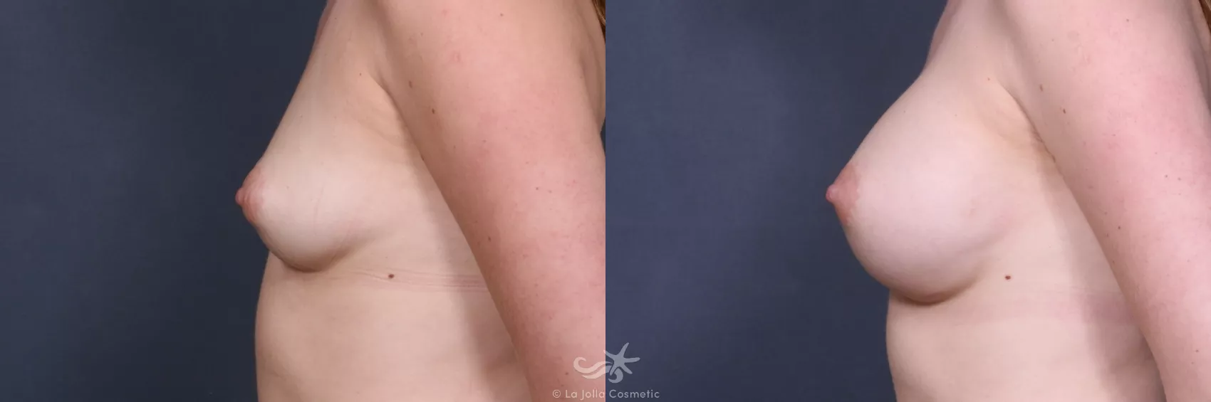 Before & After Breast Augmentation Result 251 Left Side View in San Diego, CA