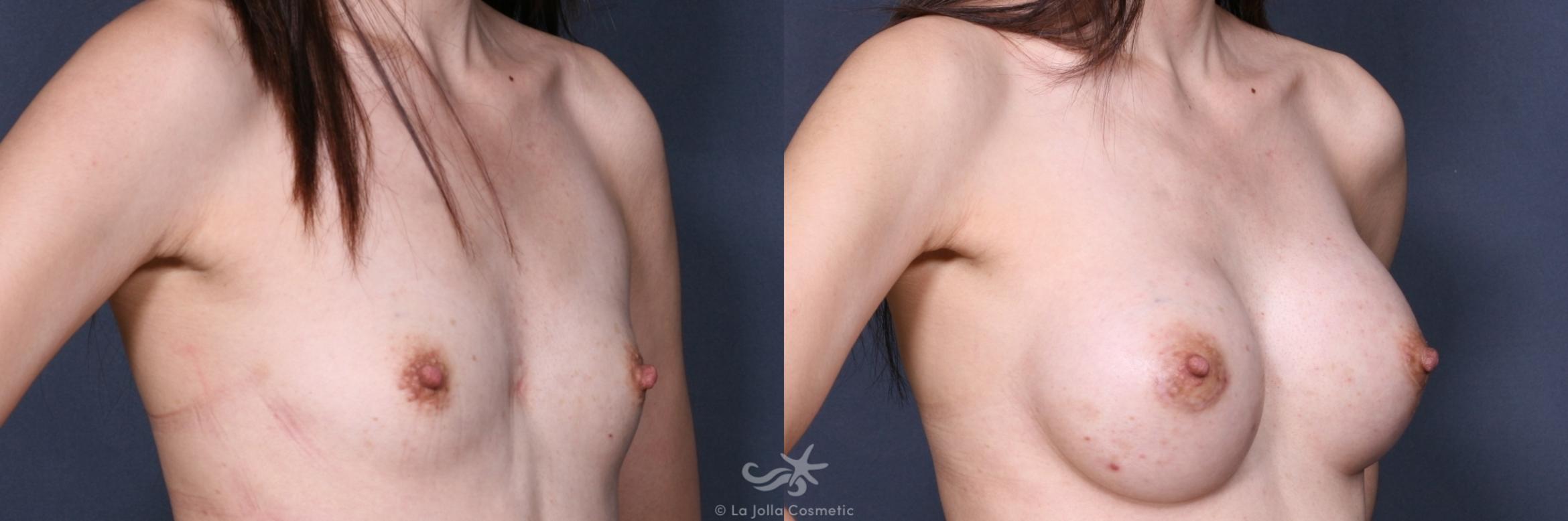 Before & After Breast Augmentation Result 252 Right Oblique View in San Diego, CA