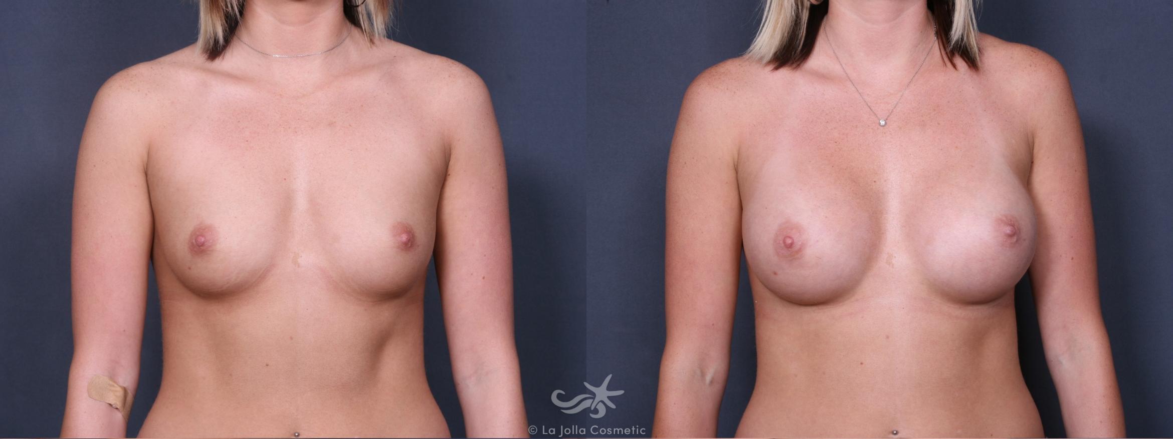 Before & After Breast Augmentation Result 257 Front View in San Diego, CA