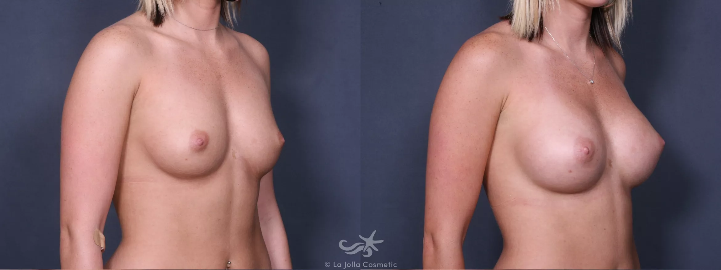 Before & After Breast Augmentation Result 257 Right Oblique View in San Diego, CA
