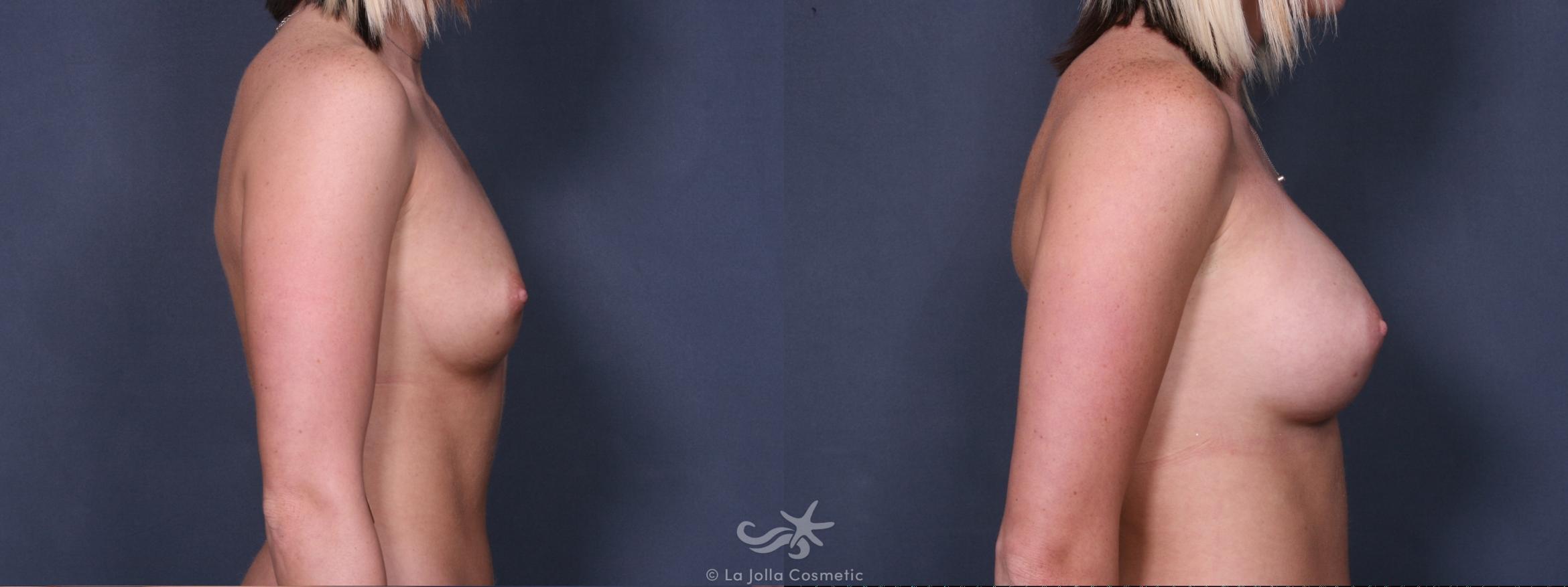 Before & After Breast Augmentation Result 257 Right Side View in San Diego, CA