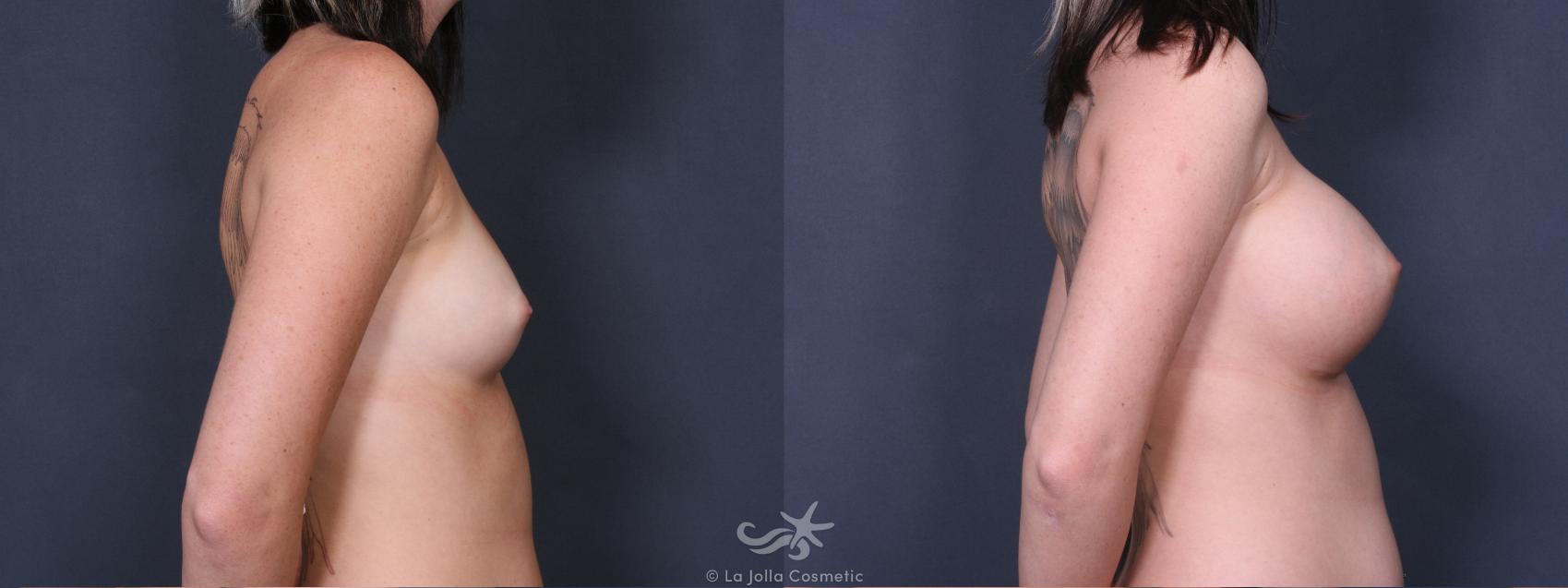 Before & After Breast Augmentation Result 258 Right Side View in San Diego, CA