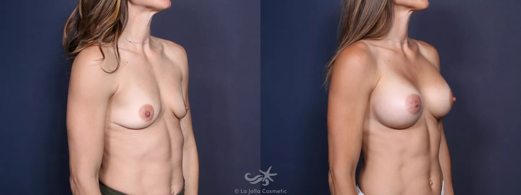 Before & After Breast Augmentation Result 26 Right Oblique View in San Diego, CA