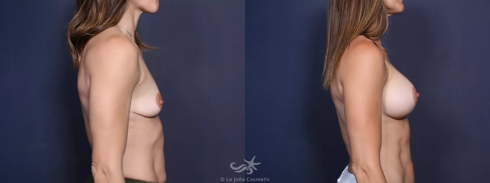 Before & After Breast Augmentation Result 26 Right Side View in San Diego, CA