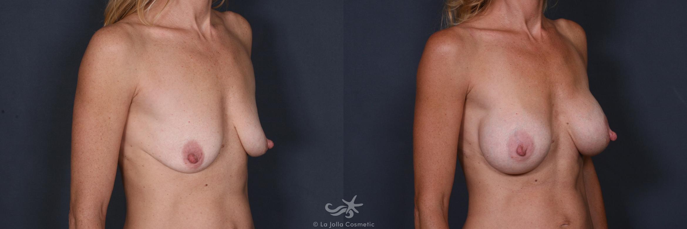 Before & After Breast Augmentation Result 260 Right Oblique View in San Diego, CA