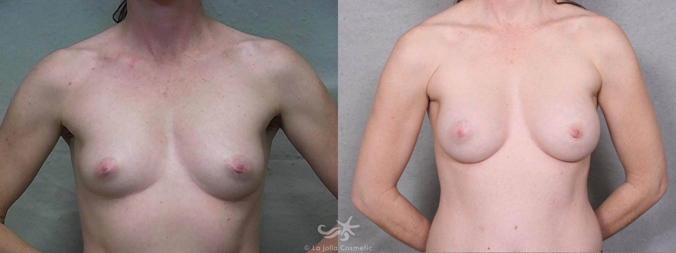 Before & After Breast Augmentation Result 261 Front View in San Diego, CA