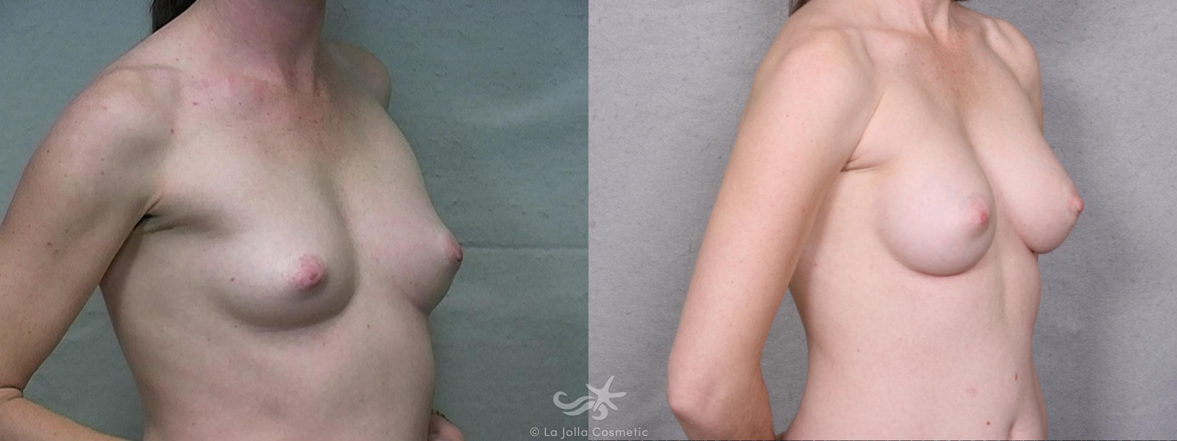 Before & After Breast Augmentation Result 261 Right Oblique View in San Diego, CA