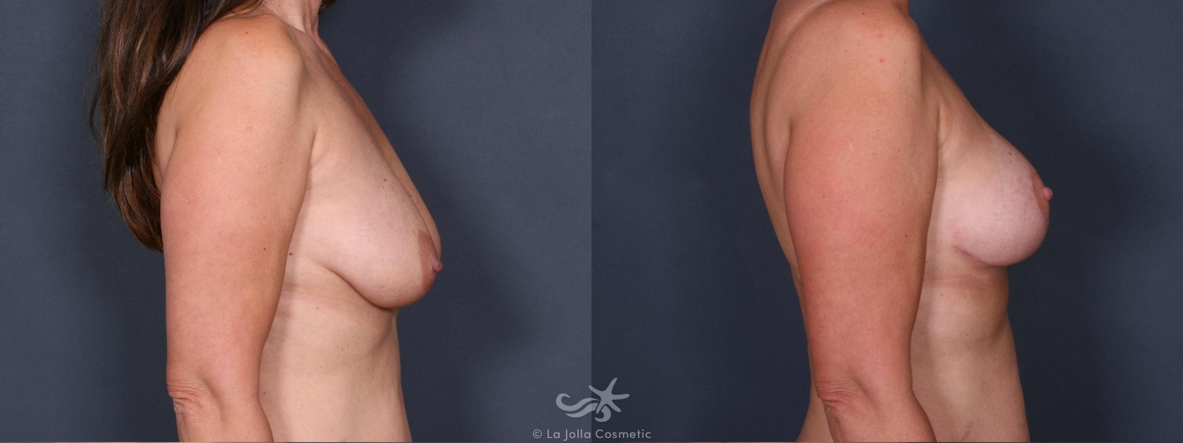 Before & After Breast Augmentation Result 263 Right Side View in San Diego, CA