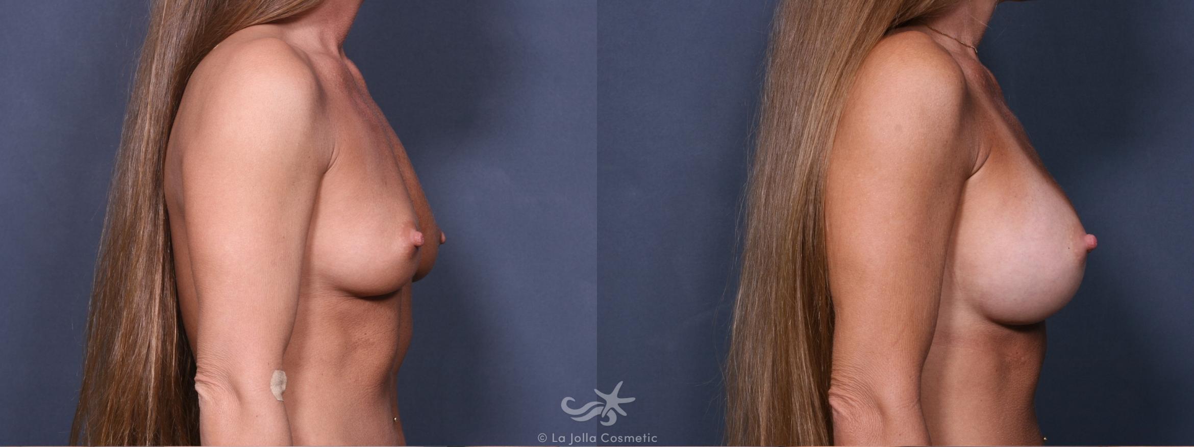 Before & After Breast Augmentation Result 265 Right Side View in San Diego, CA
