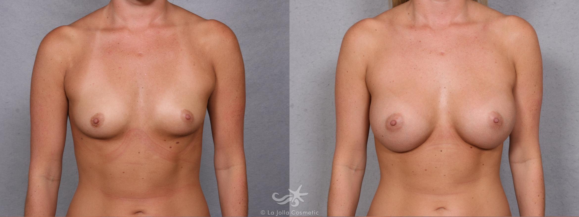 Before & After Breast Augmentation Result 269 Front View in San Diego, CA