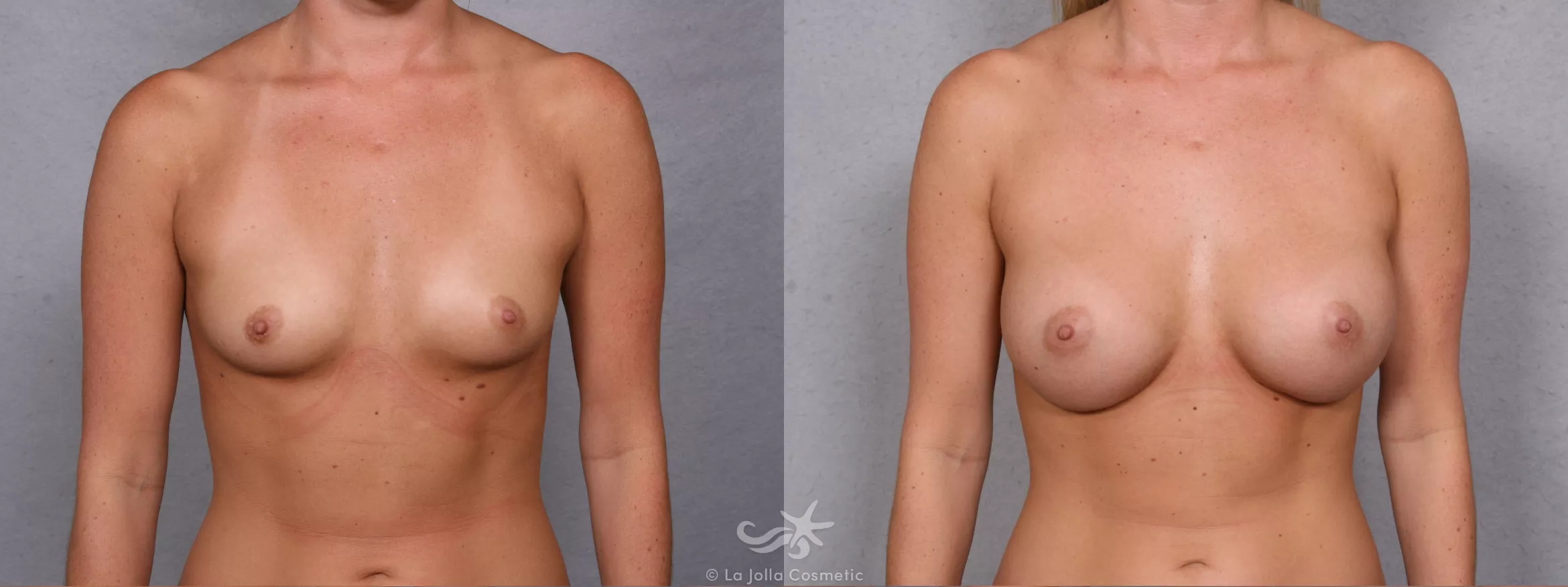 Before & After Breast Augmentation Result 269 Front View in San Diego, CA