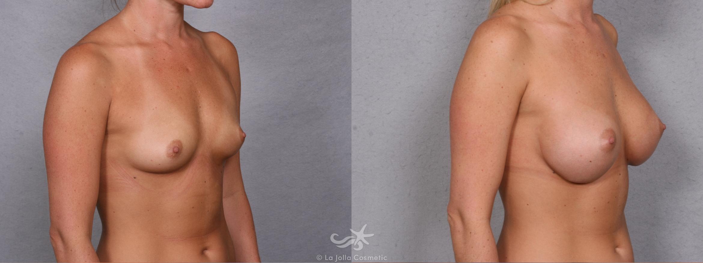 Before & After Breast Augmentation Result 269 Right Oblique View in San Diego, CA