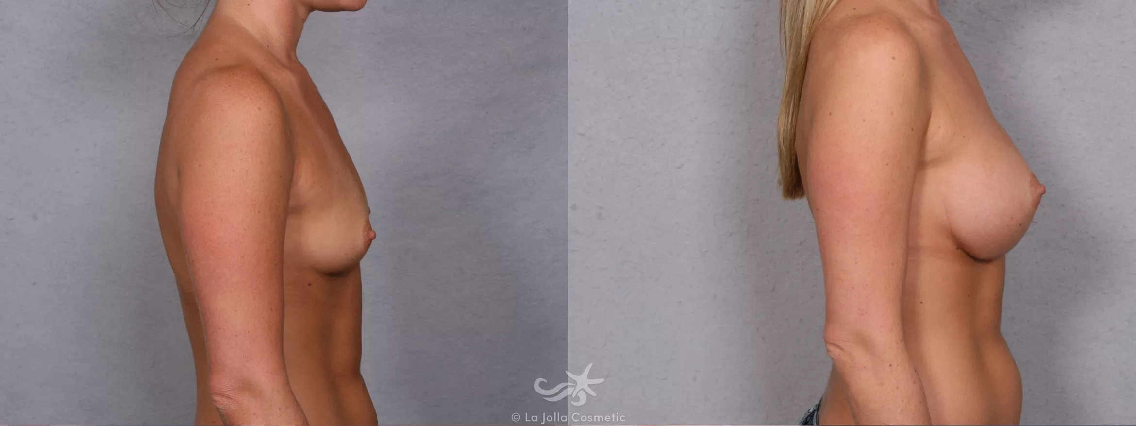 Before & After Breast Augmentation Result 269 Right Side View in San Diego, CA