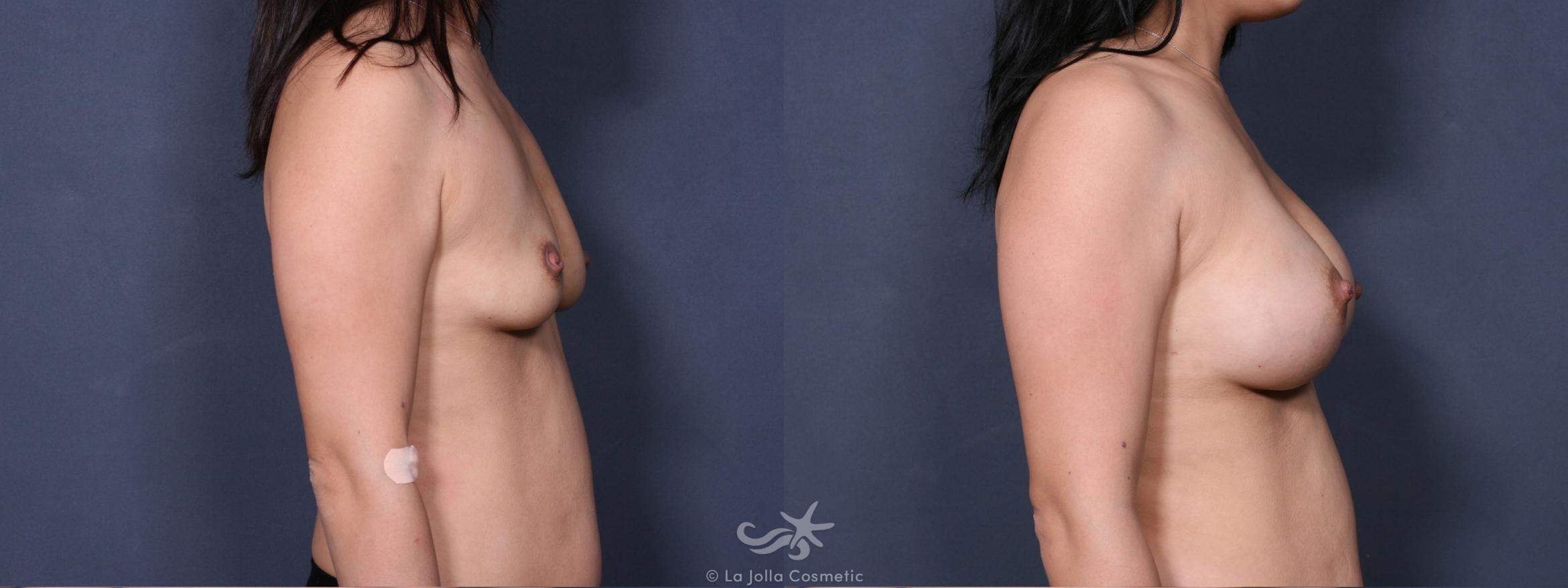 Before & After Breast Augmentation Result 270 Right Side View in San Diego, CA