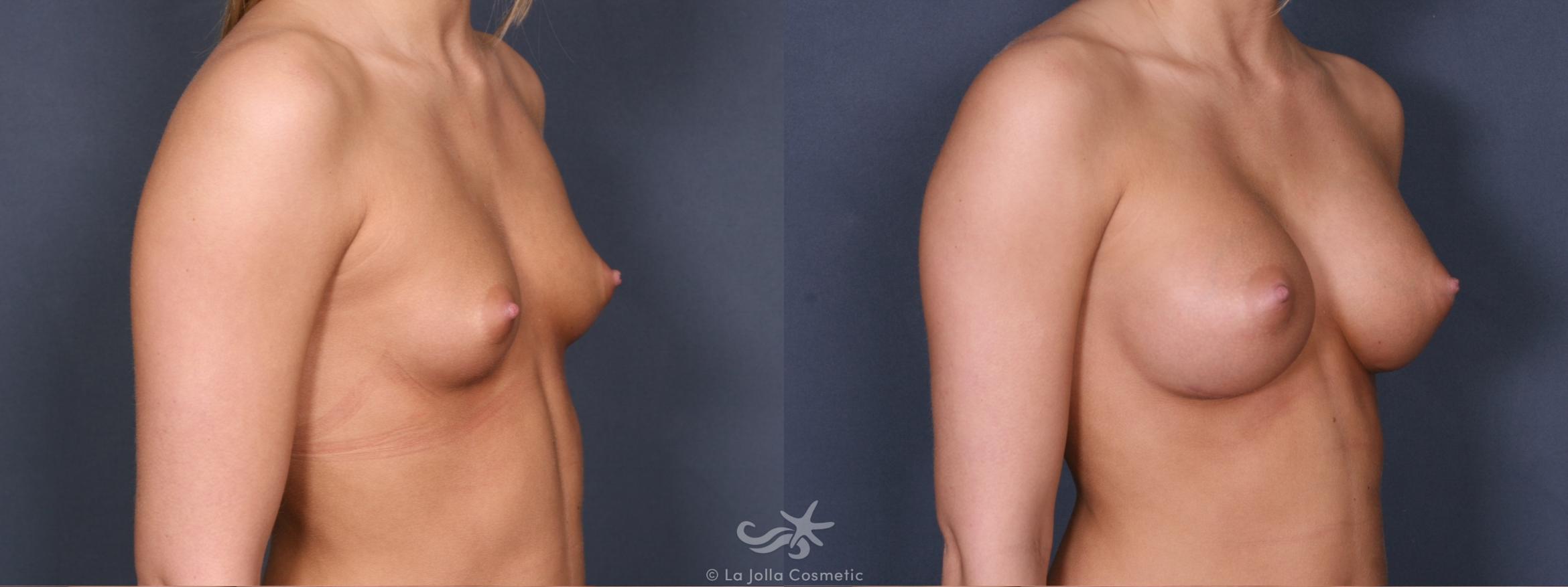 Before & After Breast Augmentation Result 271 Right Oblique View in San Diego, CA
