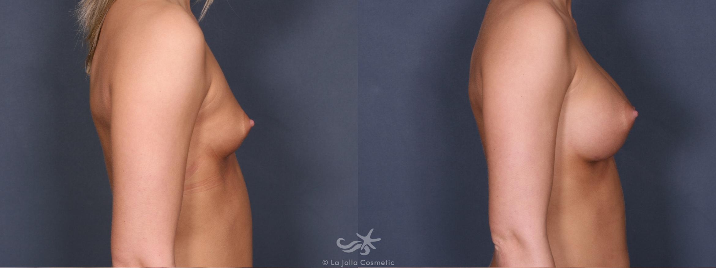Before & After Breast Augmentation Result 271 Right Side View in San Diego, CA