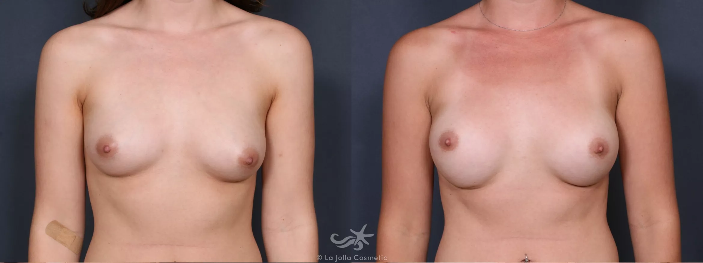 Before & After Breast Augmentation Result 272 Front View in San Diego, CA