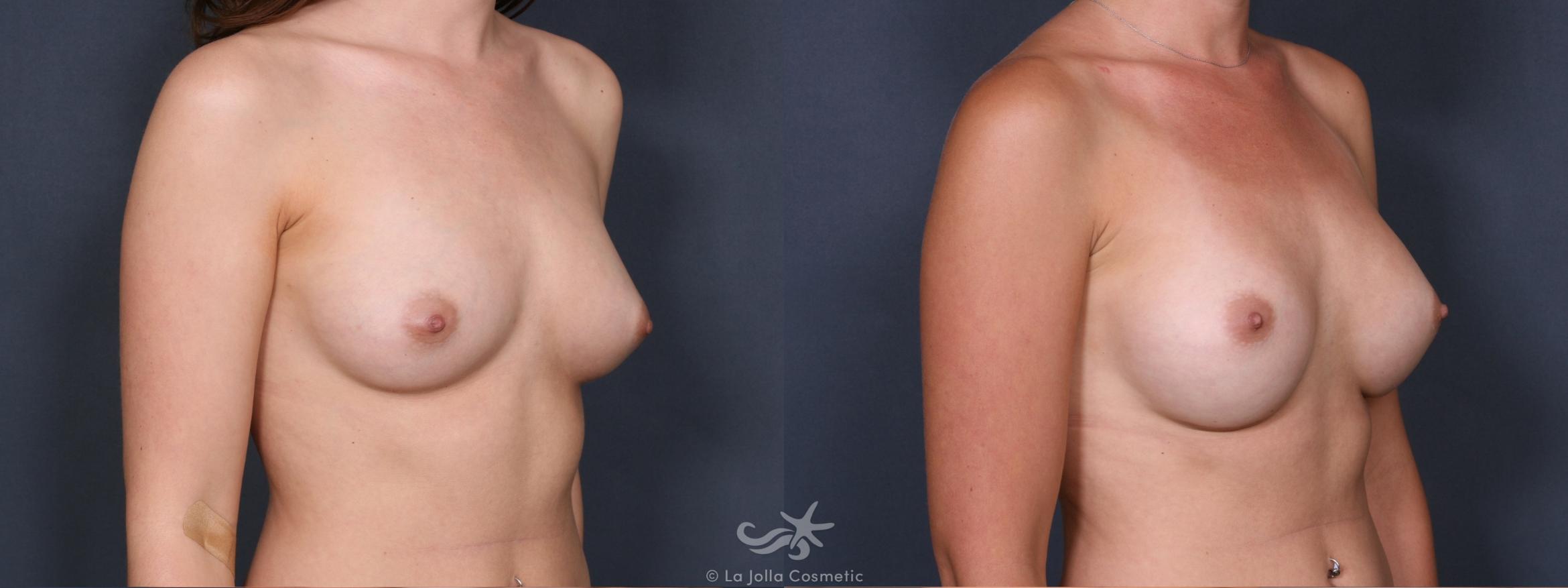 Before & After Breast Augmentation Result 272 Right Oblique View in San Diego, CA