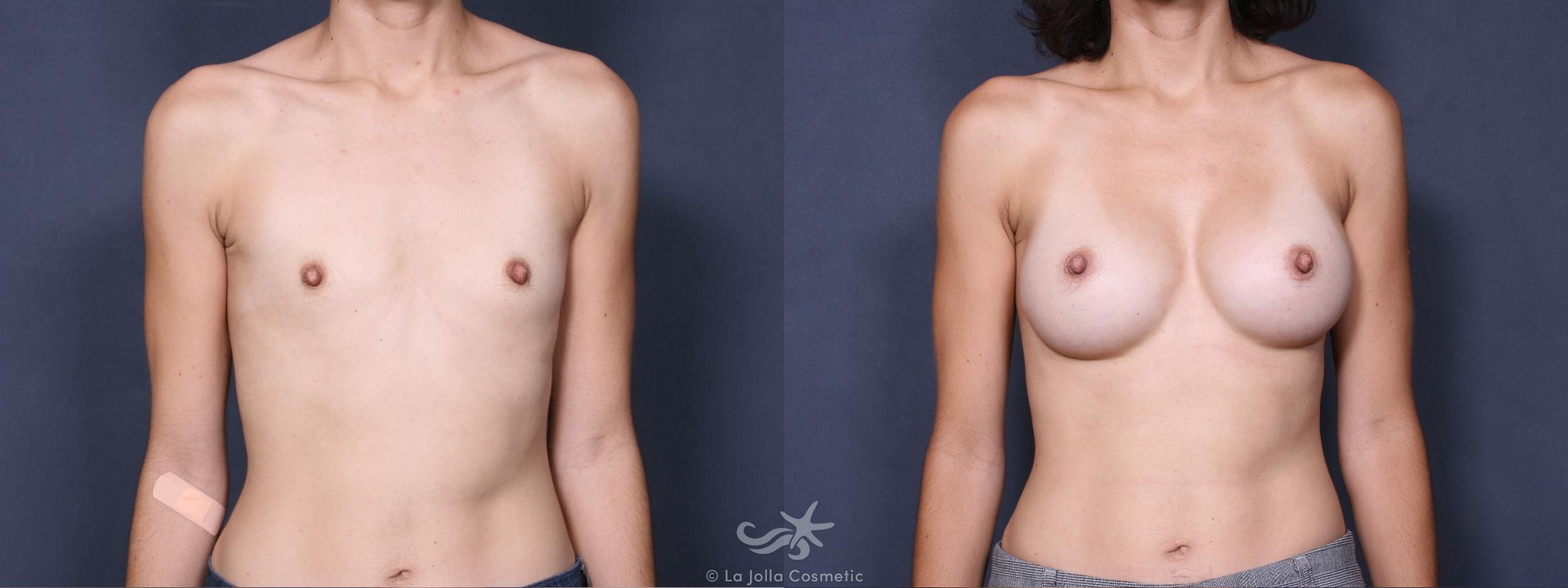 Before & After Breast Augmentation Result 273 Front View in San Diego, CA