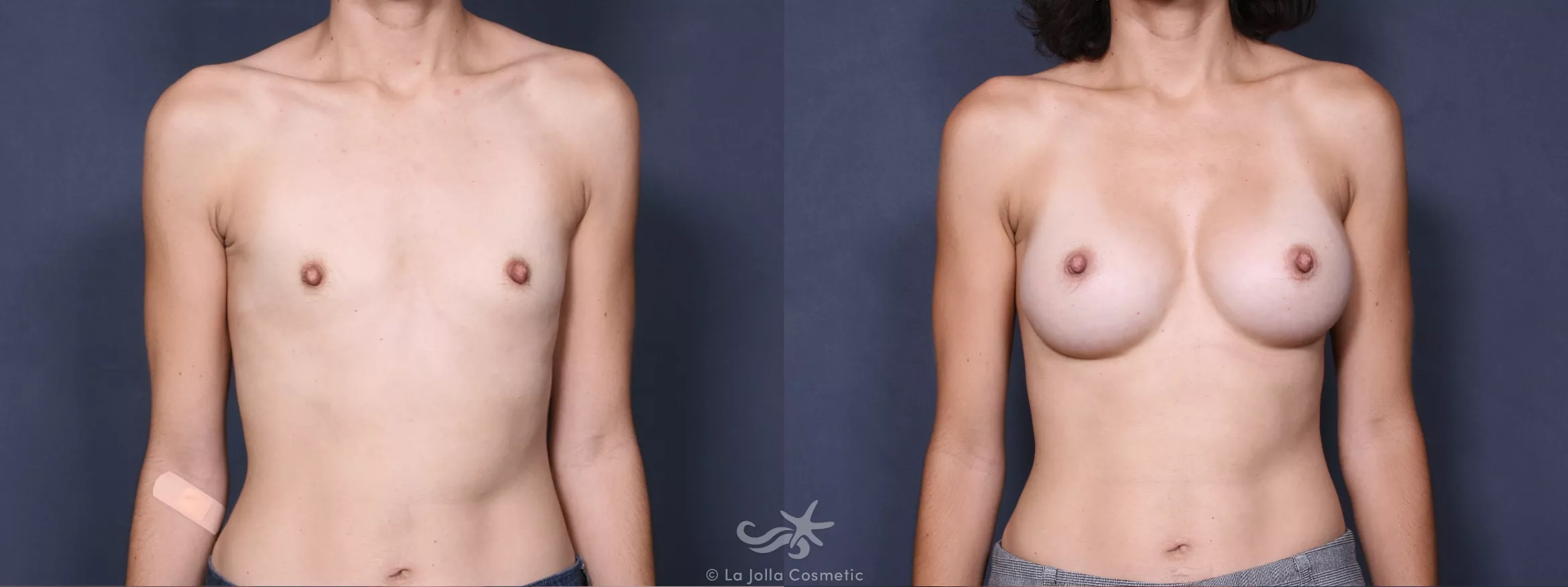Before & After Breast Augmentation Result 273 Front View in San Diego, CA