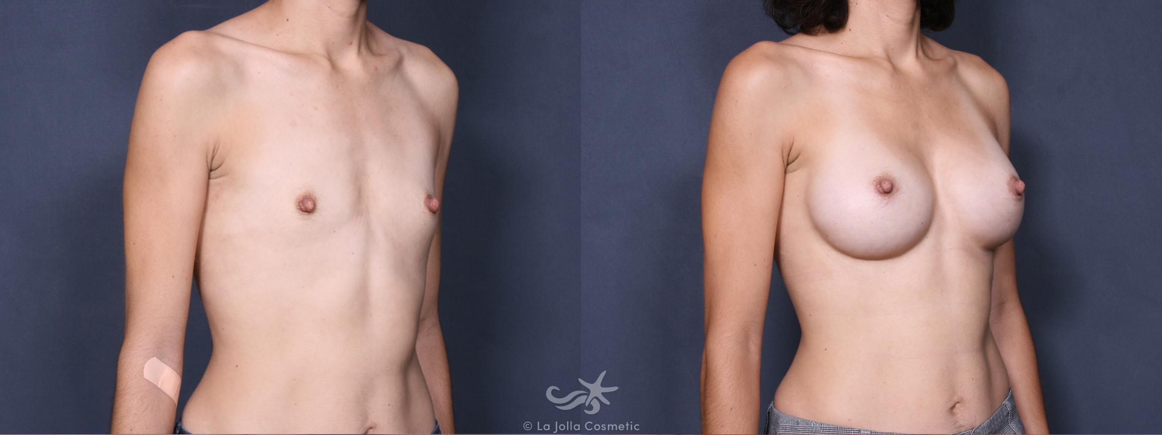 Before & After Breast Augmentation Result 273 Right Oblique View in San Diego, CA