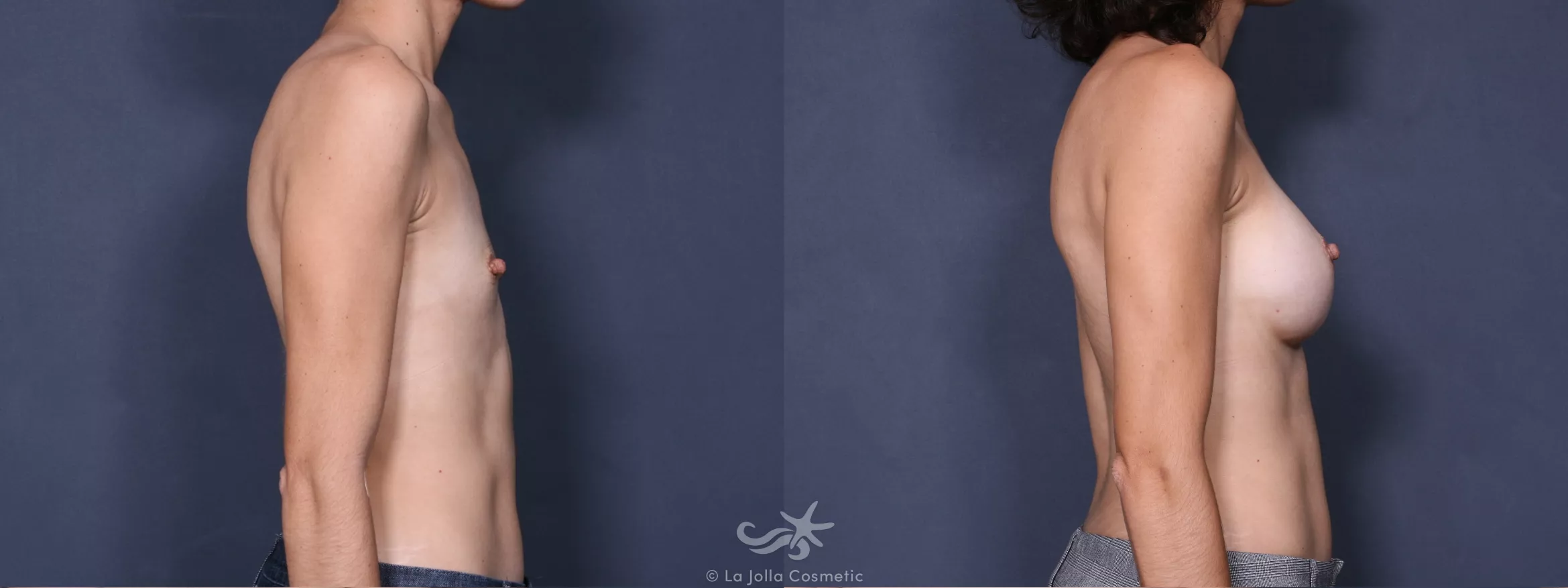 Before & After Breast Augmentation Result 273 Right Side View in San Diego, CA