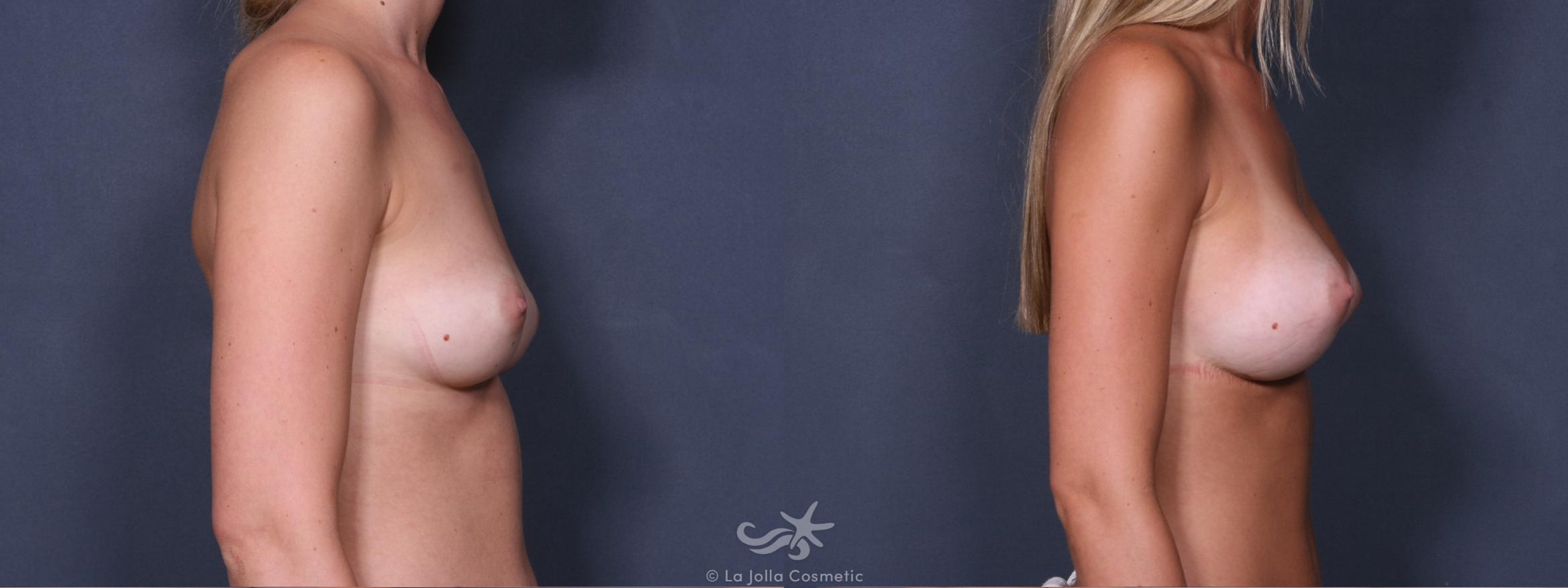 Before & After Breast Augmentation Result 275 Right Side View in San Diego, CA