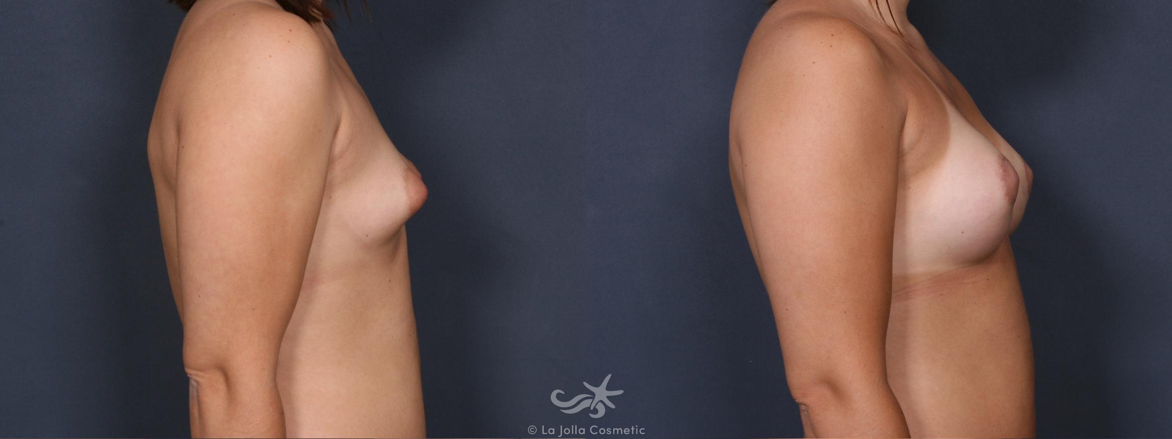 Before & After Breast Augmentation Result 278 Right Side View in San Diego, CA