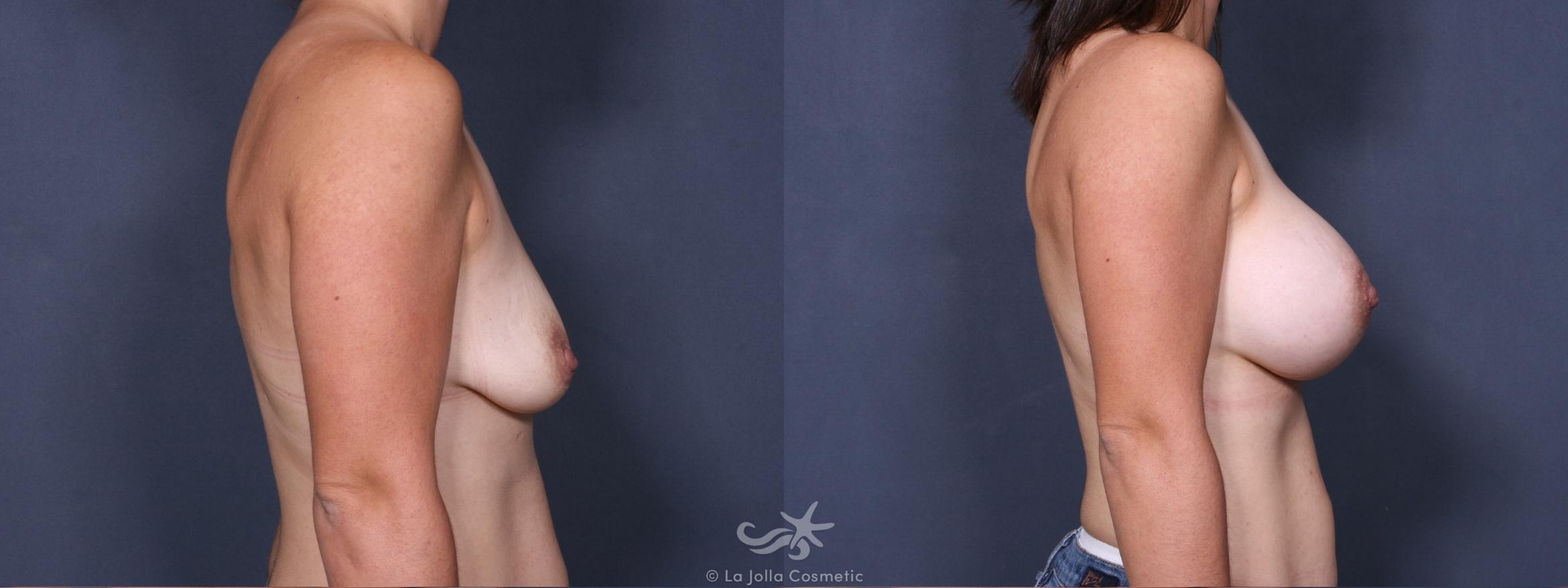 Before & After Breast Augmentation Result 279 Right Side View in San Diego, CA