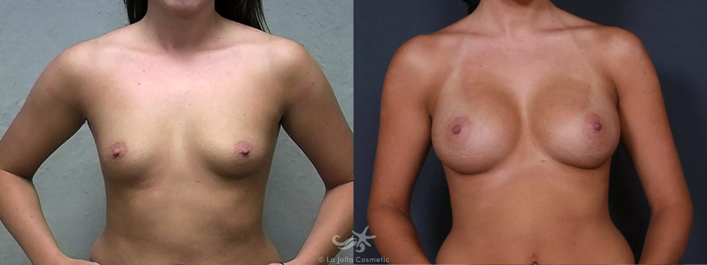 Before & After Breast Augmentation Result 280 Front View in San Diego, CA