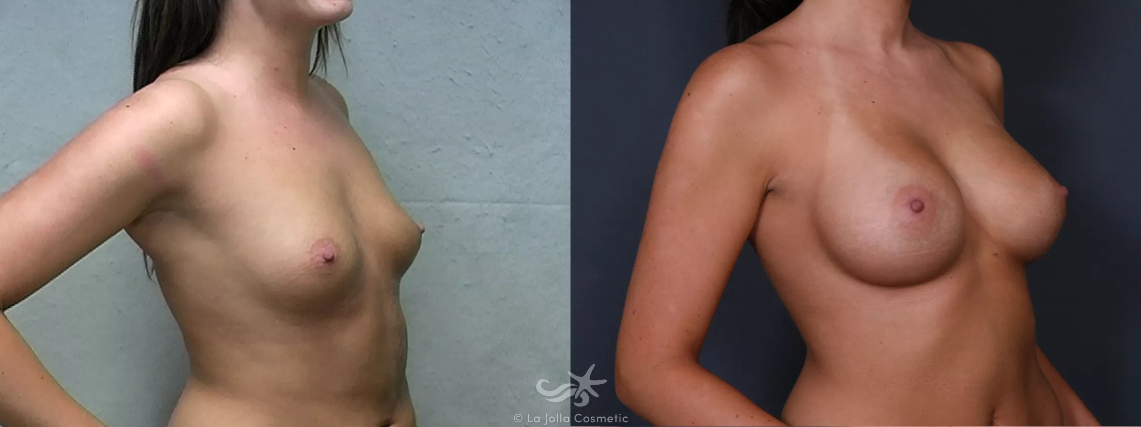 Before & After Breast Augmentation Result 280 Right Oblique View in San Diego, CA
