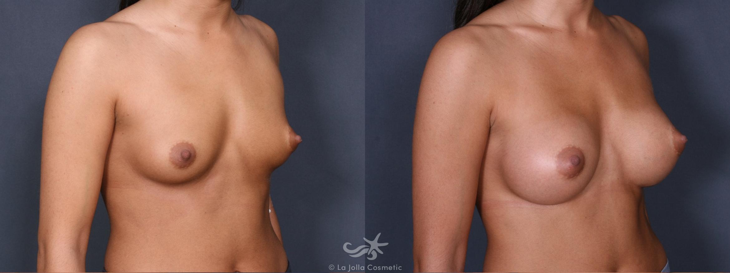 Before & After Breast Augmentation Result 282 Right Oblique View in San Diego, CA