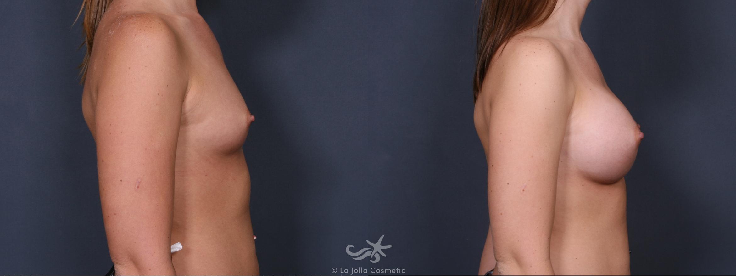 Before & After Breast Augmentation Result 283 Right Side View in San Diego, CA