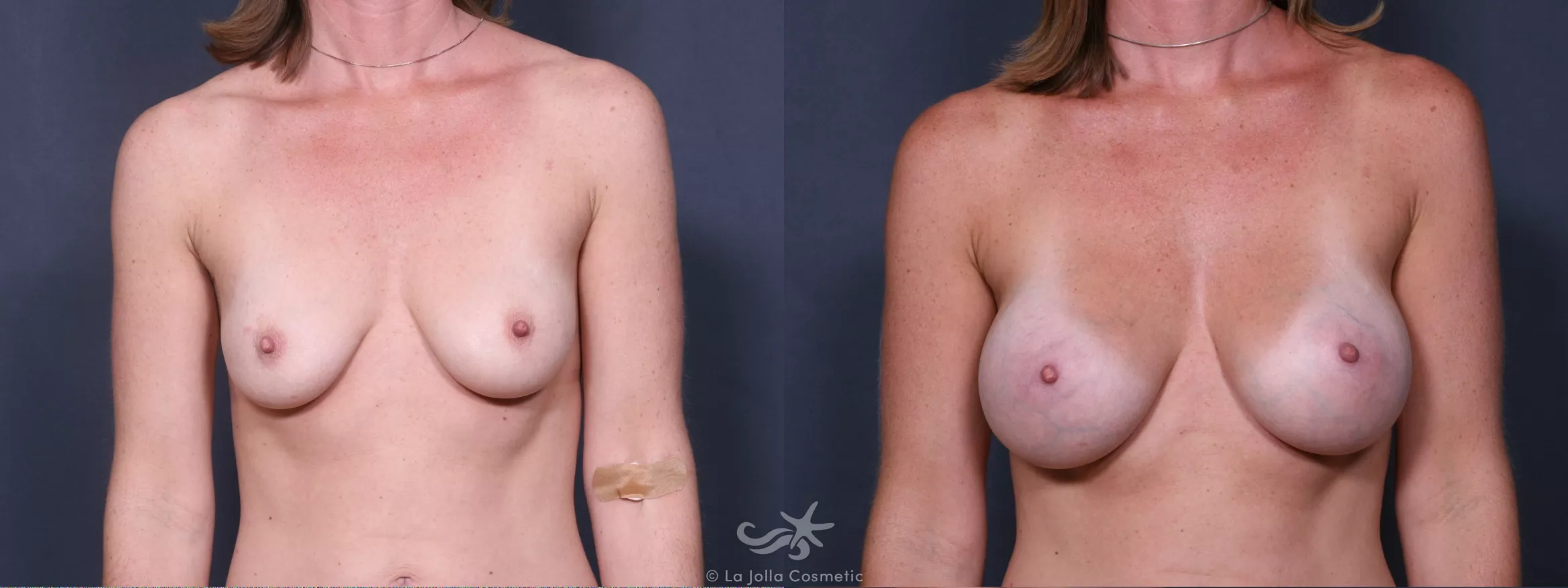 Before & After Breast Augmentation Result 285 Front View in San Diego, CA