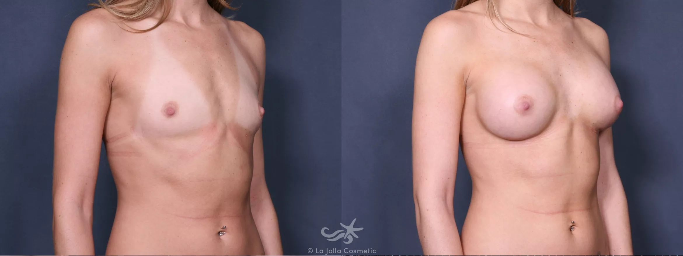 Before & After Breast Augmentation Result 286 Right Oblique View in San Diego, CA
