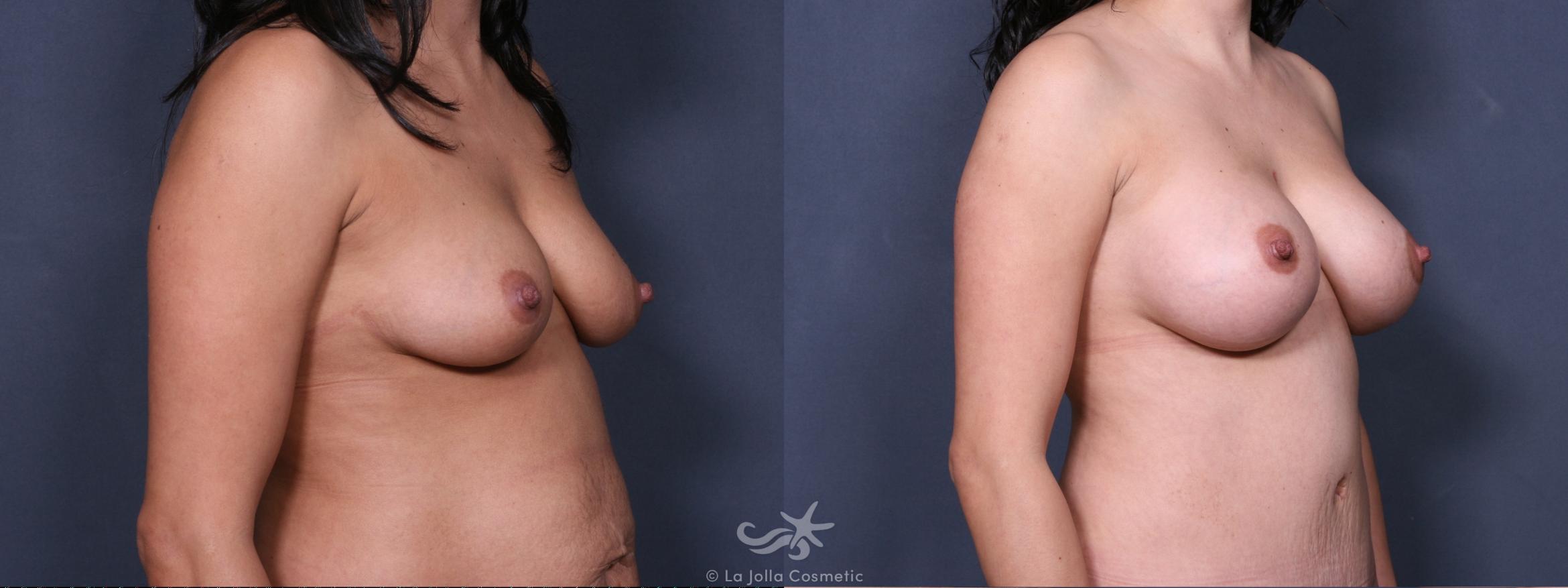 Before & After Breast Augmentation Result 288 Right Oblique View in San Diego, CA