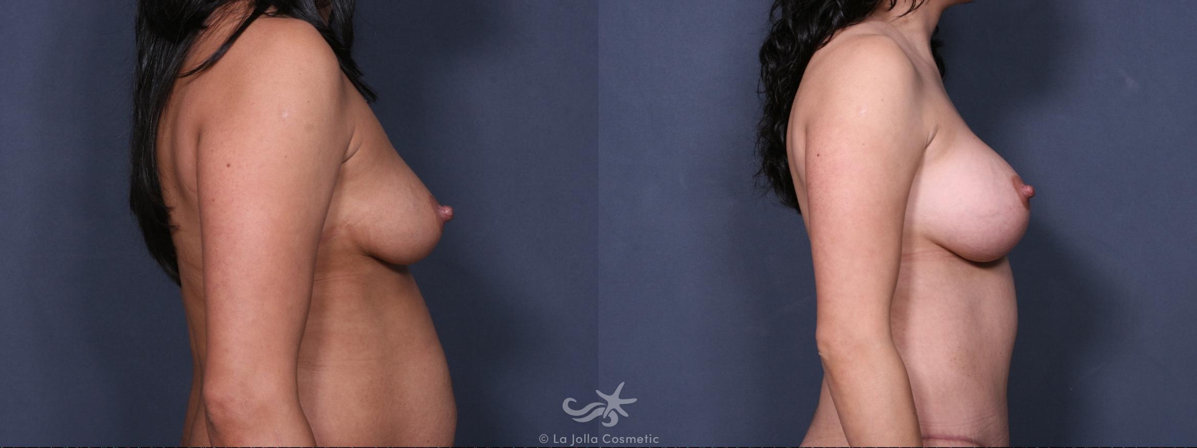 Before & After Breast Augmentation Result 288 Right Side View in San Diego, CA