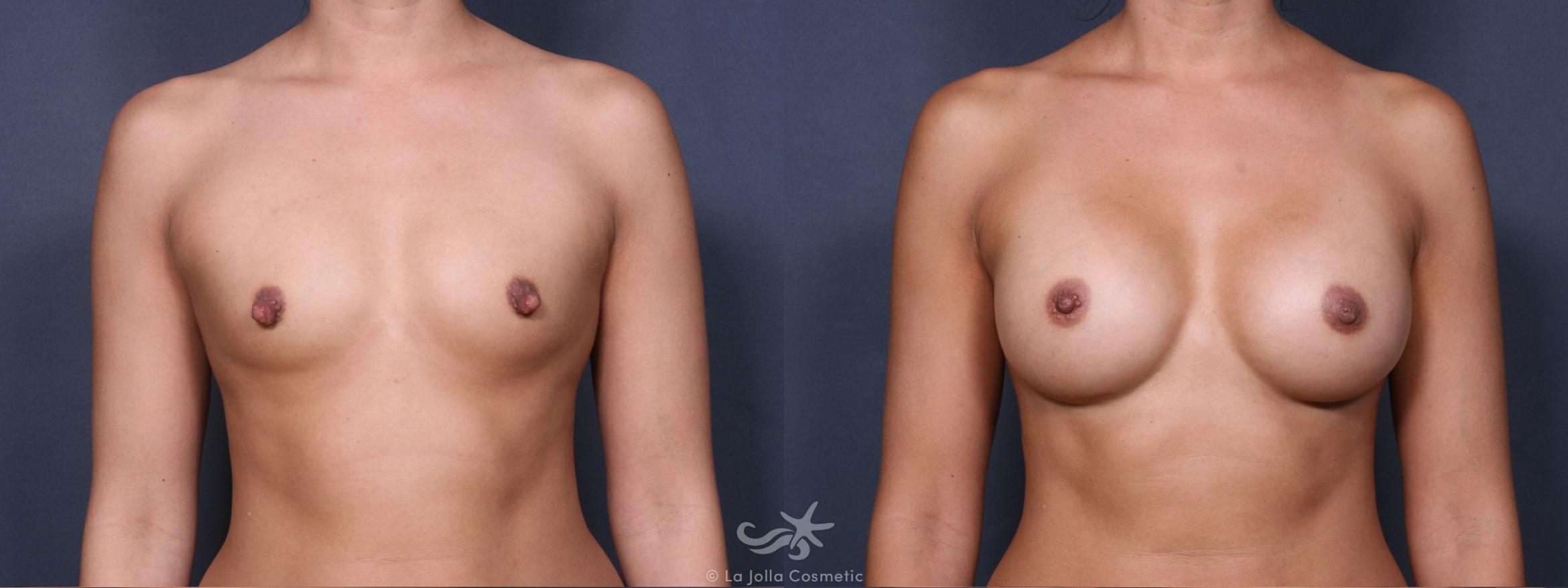 Before & After Breast Augmentation Result 290 Front View in San Diego, CA