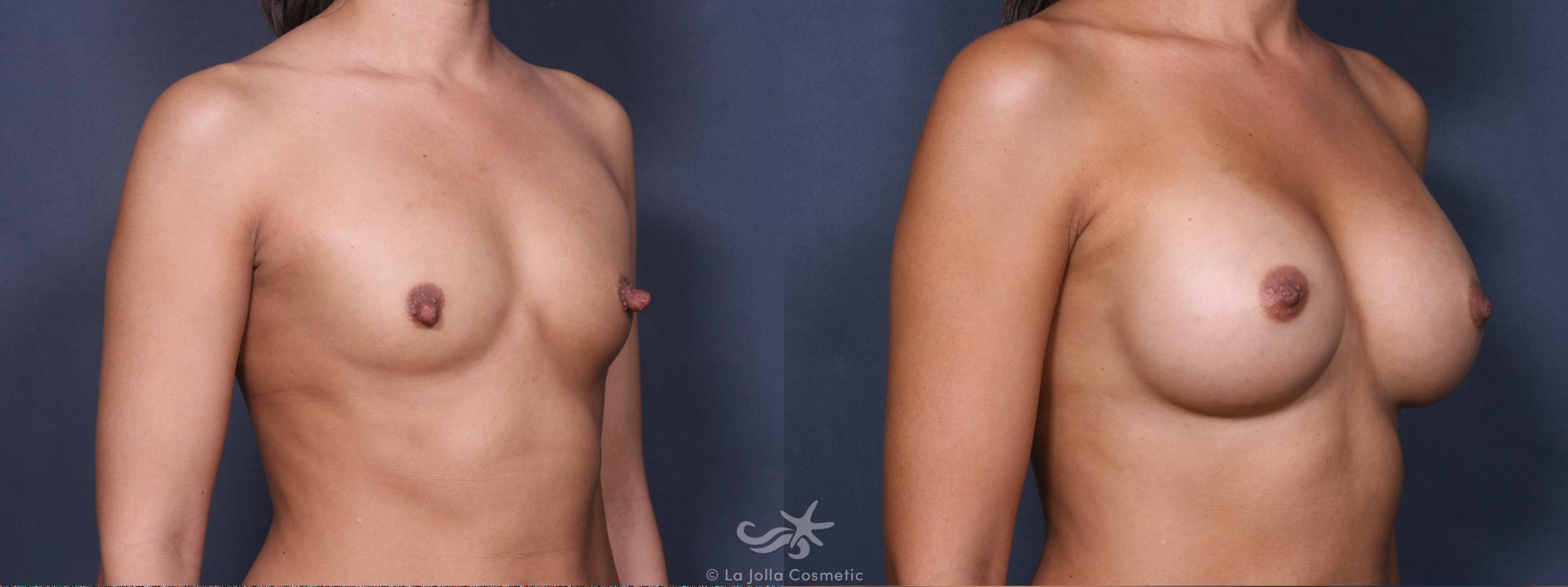 Before & After Breast Augmentation Result 290 Right Oblique View in San Diego, CA