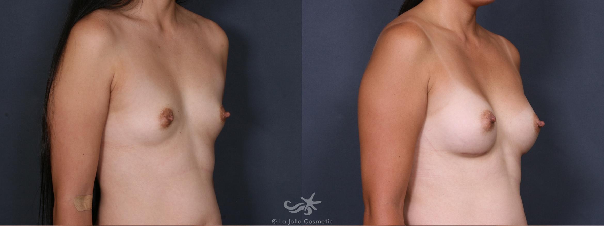 Before & After Breast Augmentation Result 291 Right Oblique View in San Diego, CA